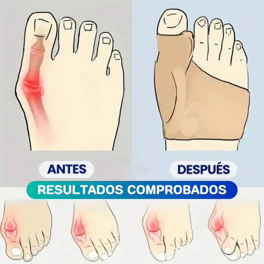 Corrector de Juanetes